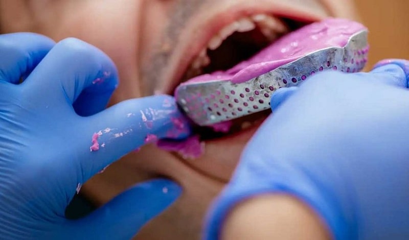 مراحل ساخت و نصب روکش پی اف ام