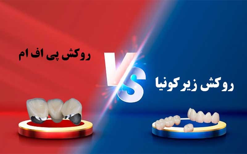 تفاوت روکش پی اف ام با زیرکونیا