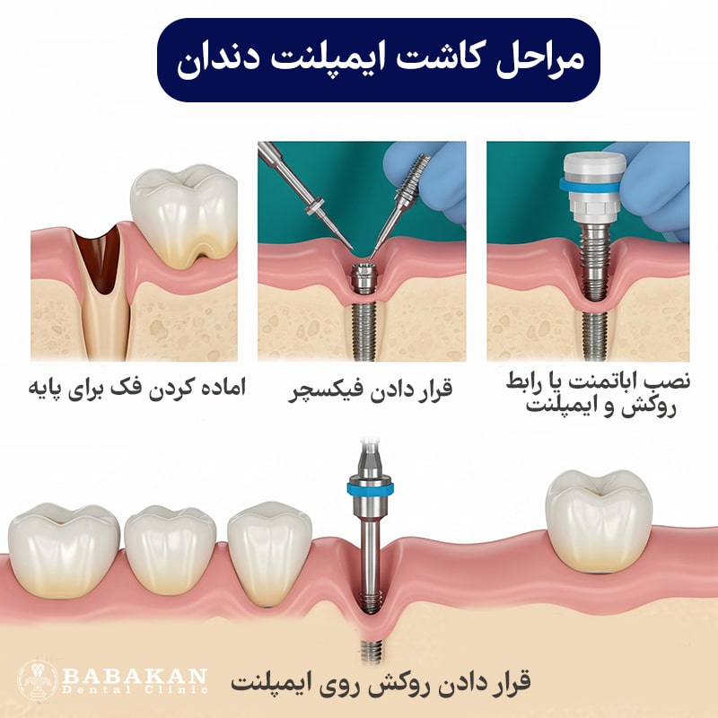 ایمپلنت دندان چگونه است