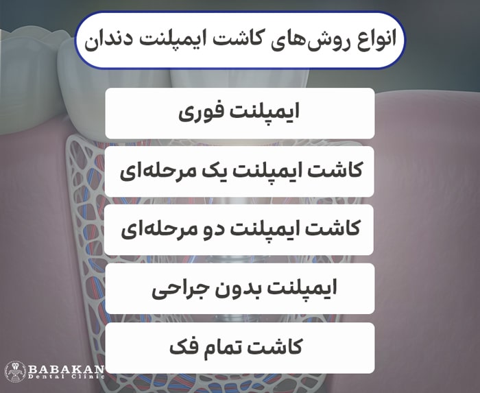 انواع روش های ایمپلنت دندان