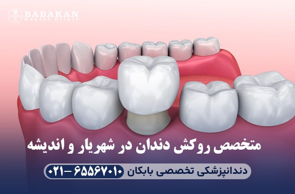 بهترین متخصص روکش دندان در شهریار و اندیشه