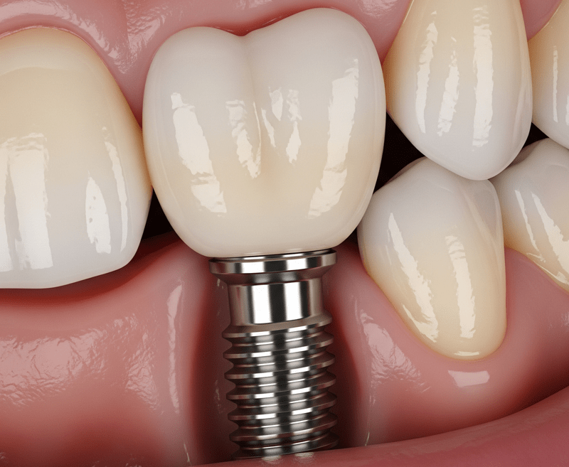 عوارض نکاشتن ایمپلنت