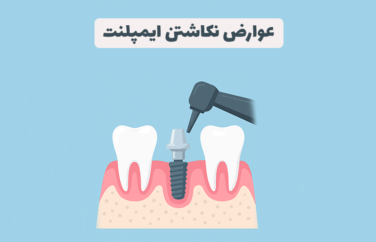 اگر ایمپلنت نکنیم چه میشود