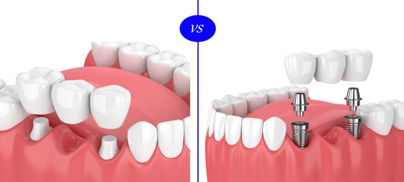 ایمپلنت بهتره یا بریج