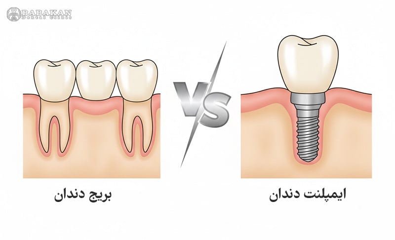ایمپلنت بهتره یا بریج دندان