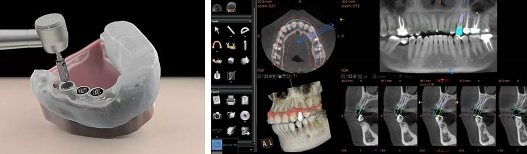 ایمپلنت معمولی یا دیجیتالی