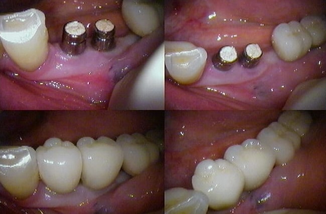 تفاوت ایمپلنت فوری با معمولی
