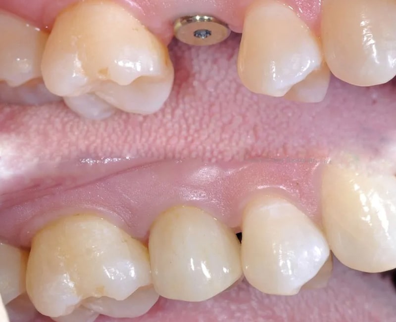 تفاوت ایمپلنت فوری با معمولی