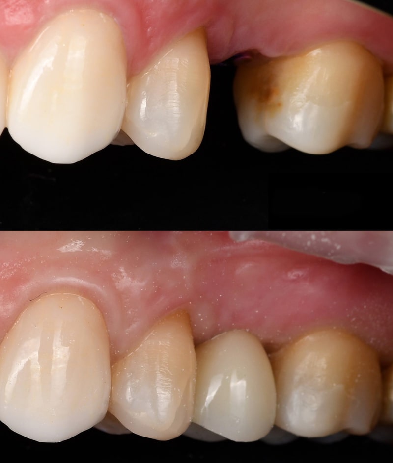 فرق ایمپلنت دندان معمولی با فوری