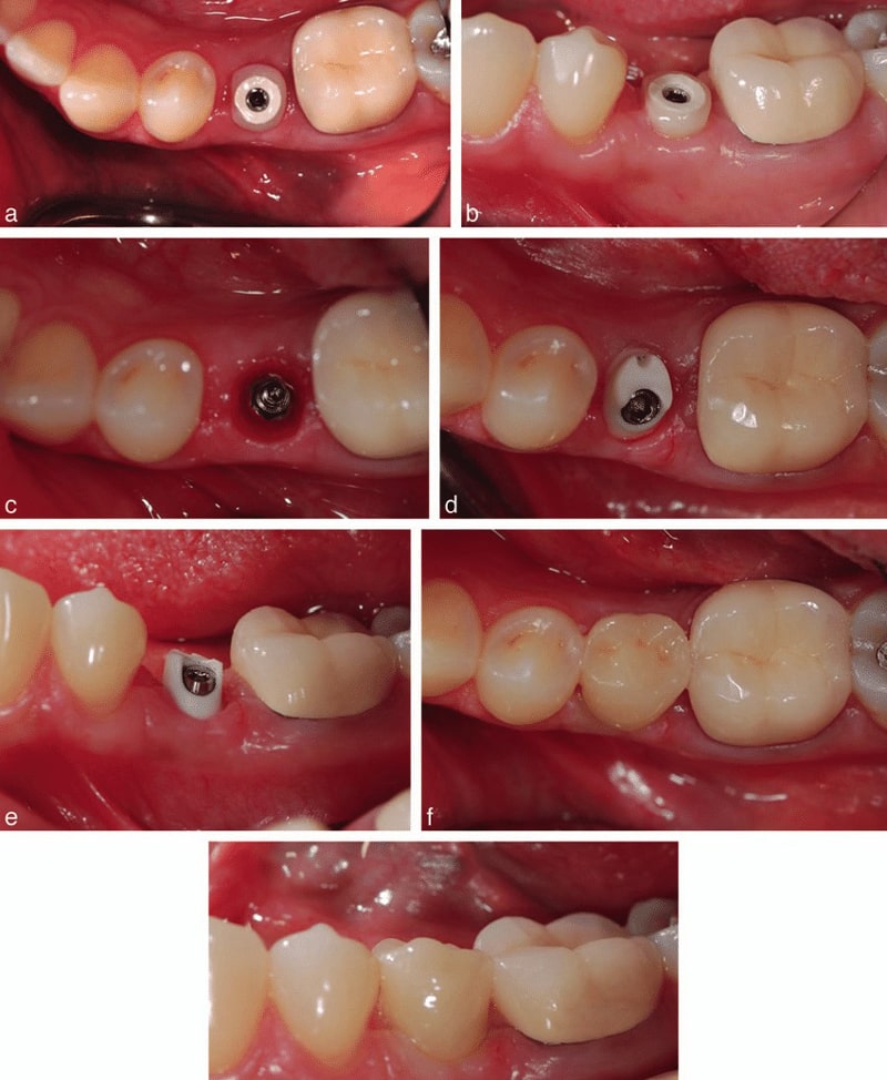 ایمپلنت یا پست و روکش