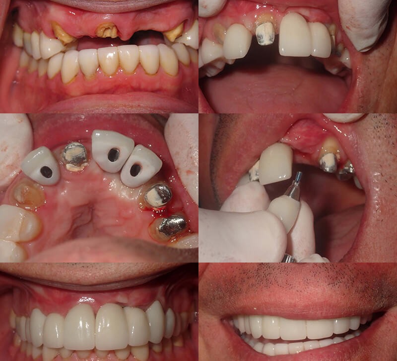 کاشت ایمپلنت و پست و روکش