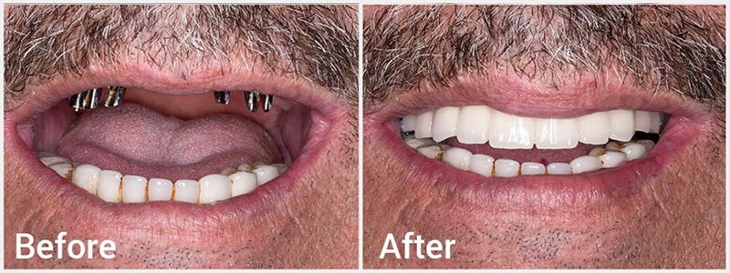 هزینه ایمپلنت فک بالا