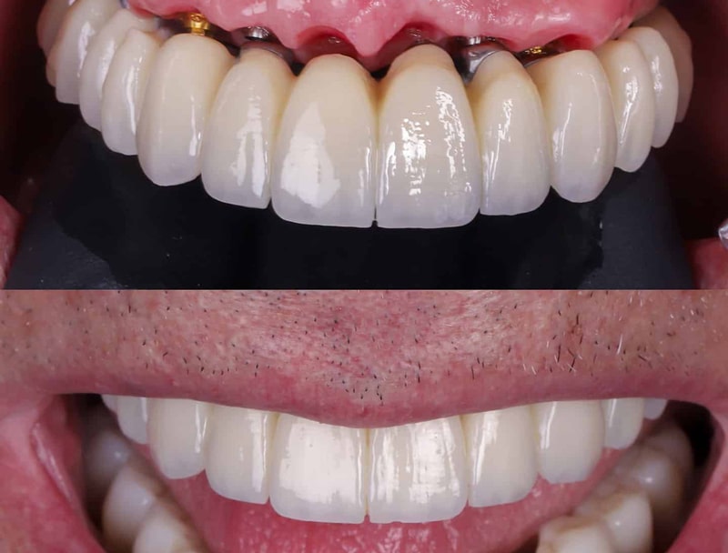 قیمت ایمپلنت فک بالا