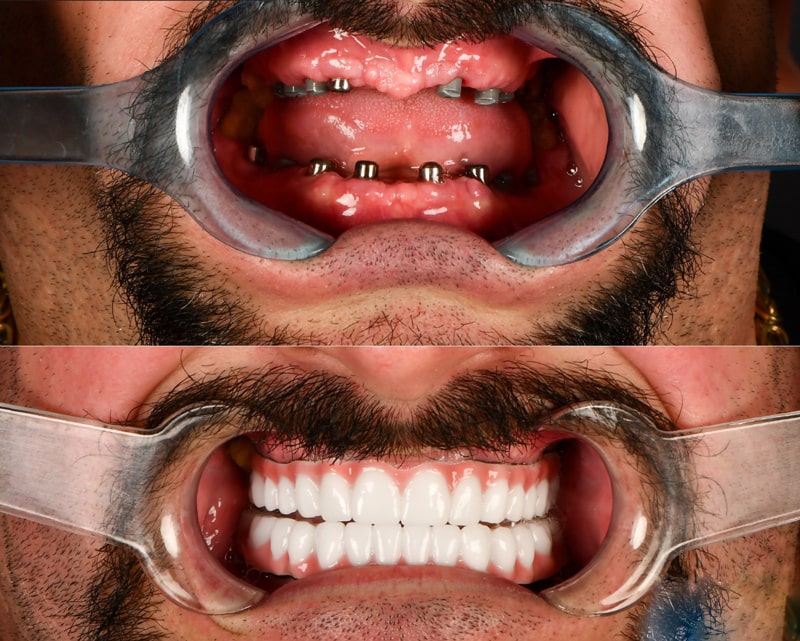 هزینه کاشت تعداد زیاد ایمپلنت در فک بالا