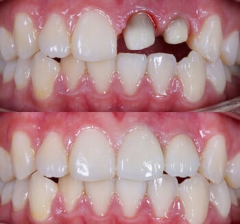 کاشت ایمپلنت و پست و روکش