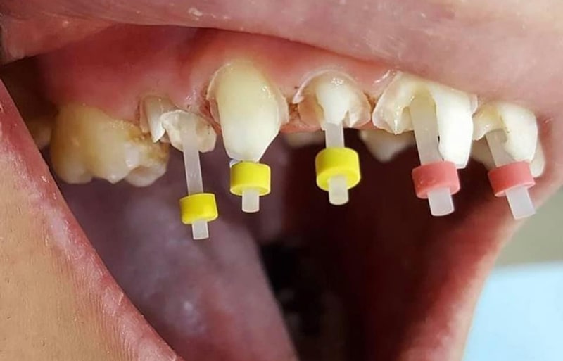 ایمپلنت و پست و روکش