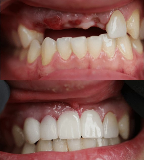 فرق ایمپلنت دندان معمولی با فوری