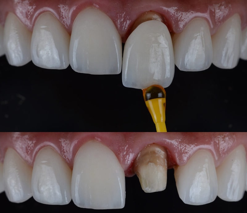 عکس دندان روکش شده