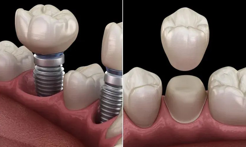 ایمپلنت، پست یا روکش
