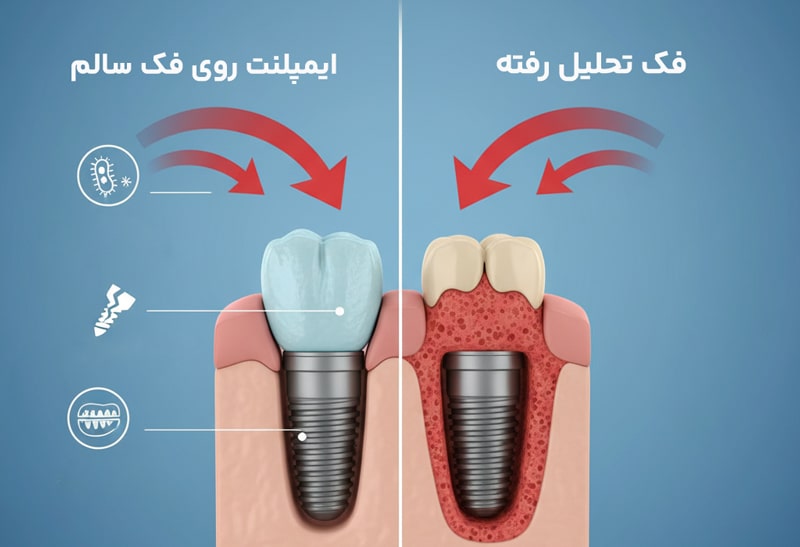 آیا ایمپلنت باعث تحلیل استخوان فک می شود