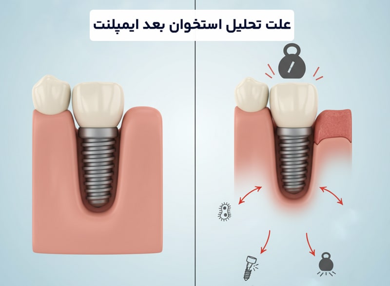 علت تحلیل استخوان فک بعد ایمپلنت