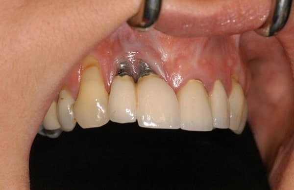 تحلیل فک بعد از ایمپلنت