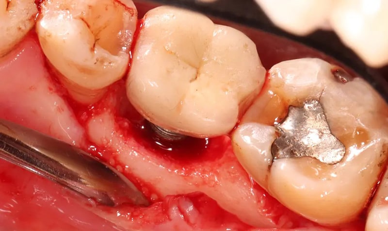 تحلیل استخوان فک بعد از ایمپلنت