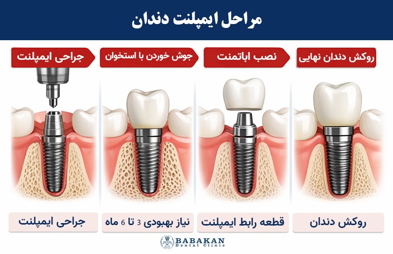 مراحل ایمپلمنت دندان