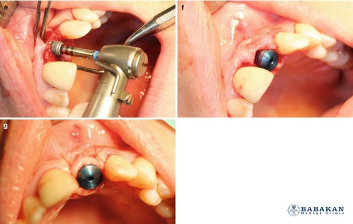 مراحل ایمپلنت دندان تصویری