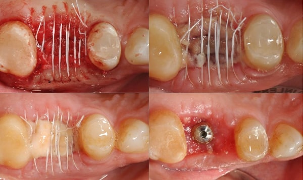 مراحل ایمپلنت دندان