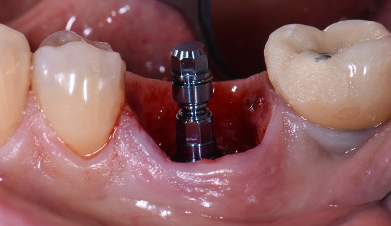 مرحله ایمپلنت دندان