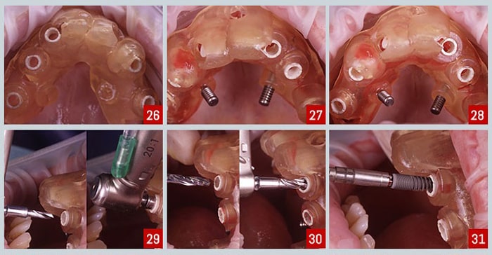 مراحل ایمپلنت دندان