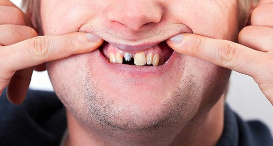 شل شدن ایمپلنت دندان