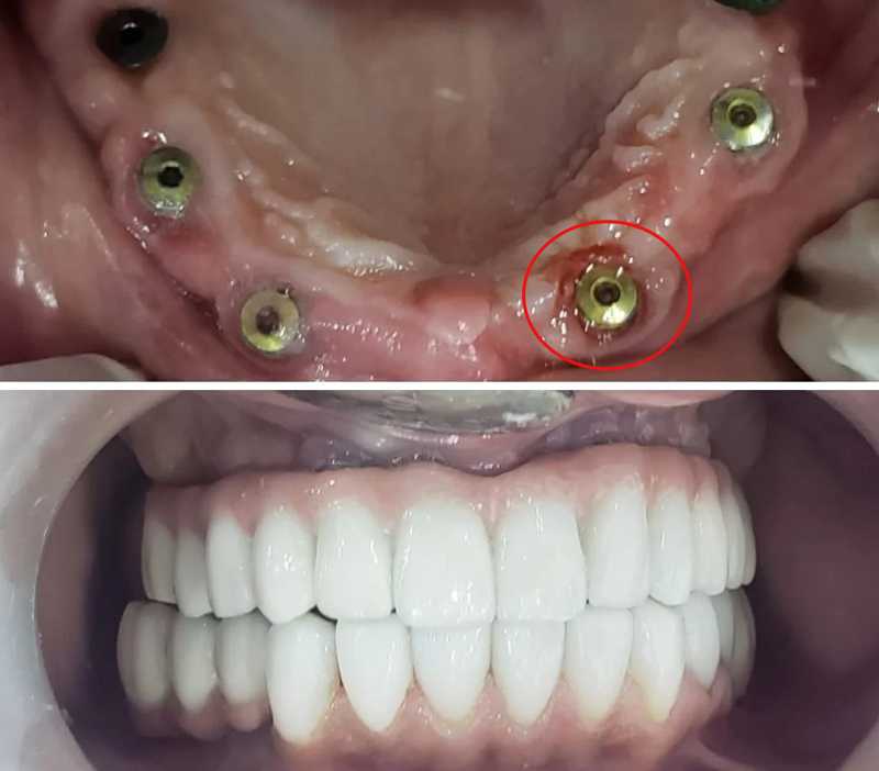 علائم پس زدن ایمپلنت