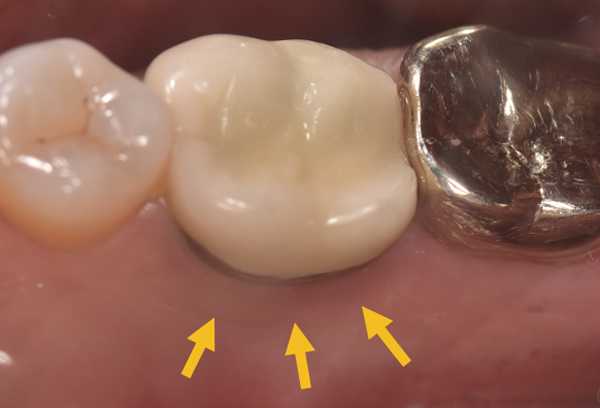 علائم پس زدن ایمپلنت دندان