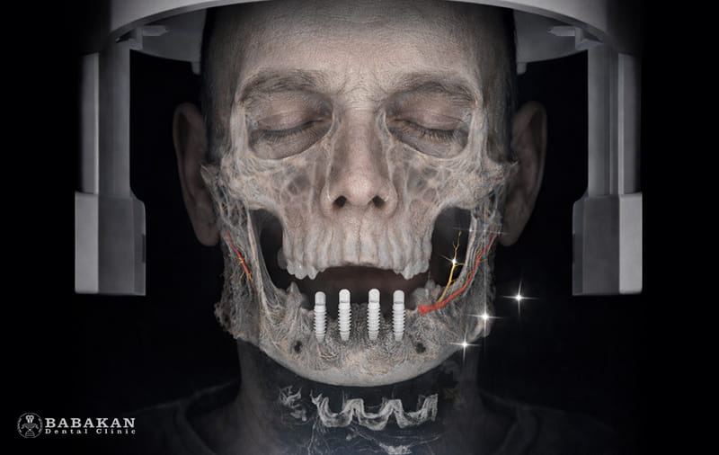 علت نیاز به تصویر برداری CBCT برای ایمپلنت دندان