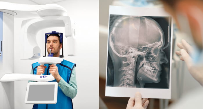 کاربرد عکس CBCT برای ایمپلنت