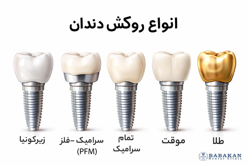 بهترین روکش ایمپلنت دندان