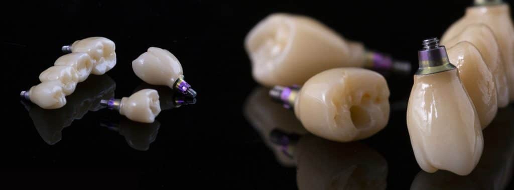 روکش ایمپلنت