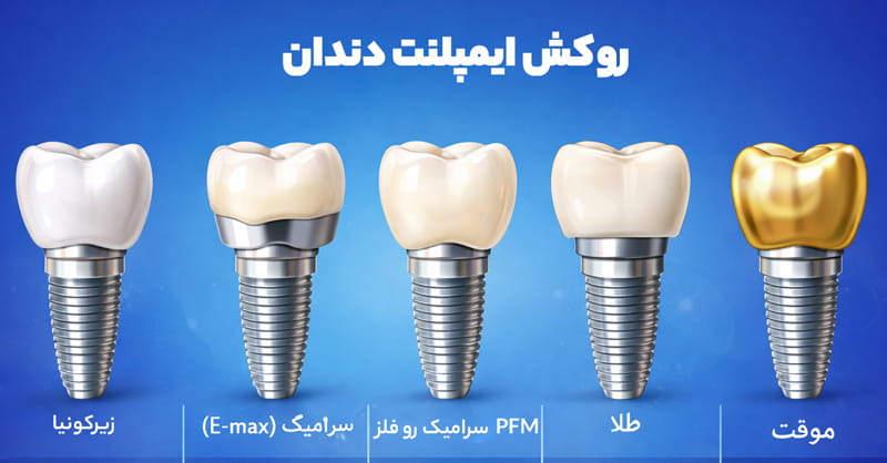 انواع روکش ایمپلنت دندان