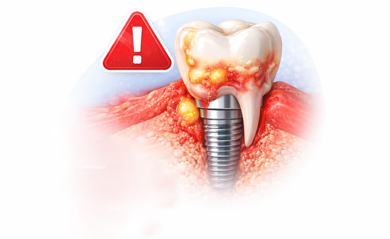 عفونت ایمپلنت دندان