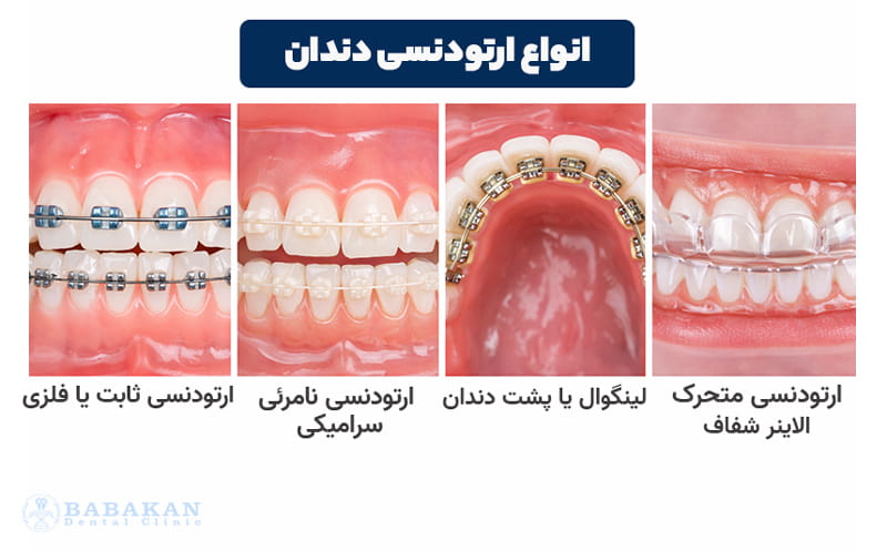 انواع ارتودنسی دندان
