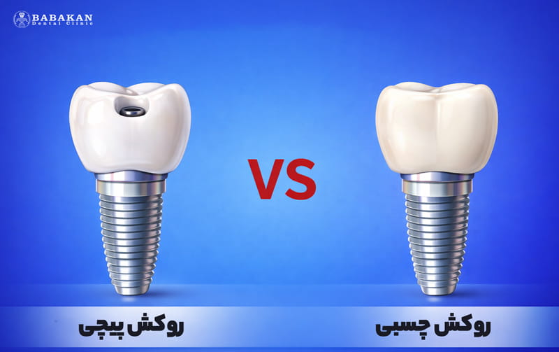انواع روکش ایمپلنت از نظر نوع اتصال به ایمپلنت