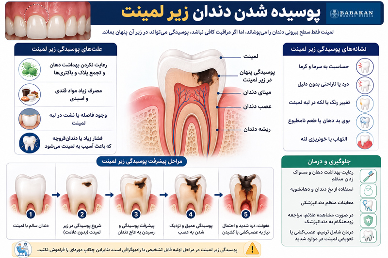 پوسیده شدن دندان زیر لمینت