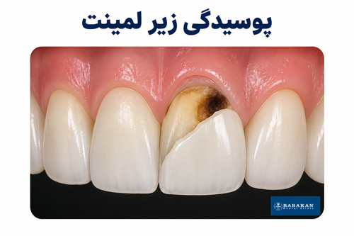 پوسیدگی دندان زیر لمینت
