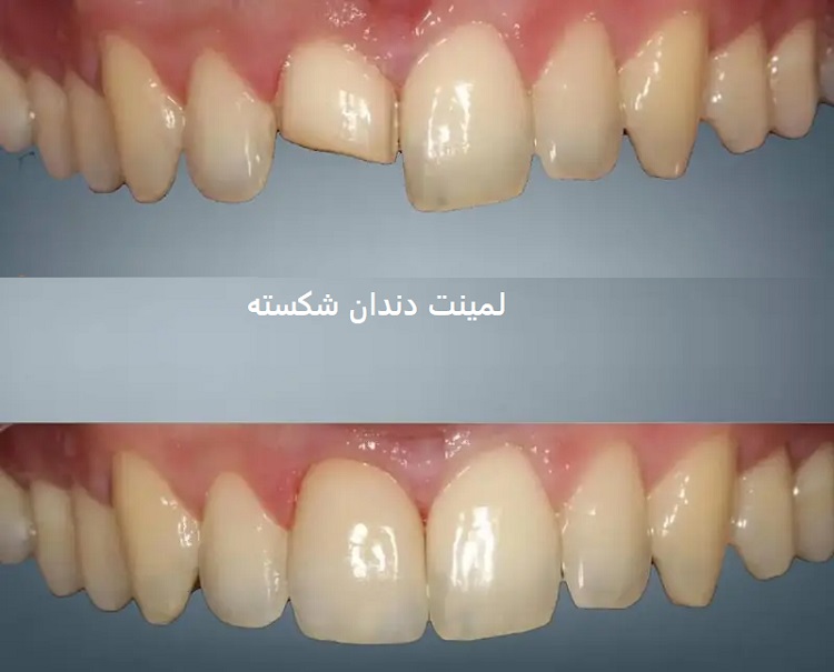 لمینت دندان شکسته