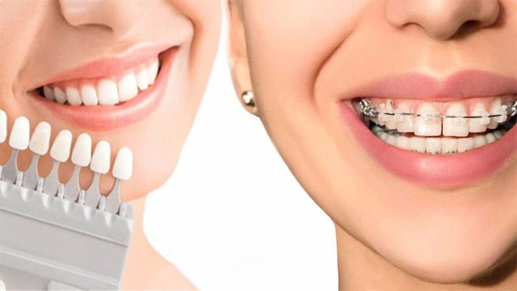 ارتودنسی بهتره یا لمینت