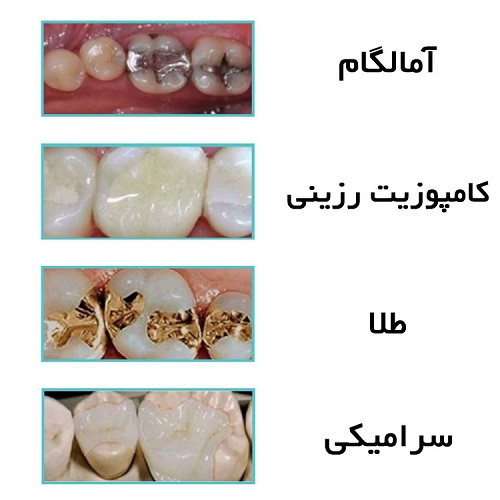بهترین مواد پرکننده دندان