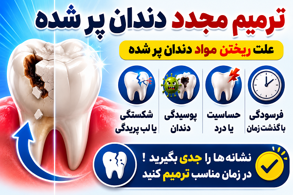 علت ریختن مواد دندان پر شده