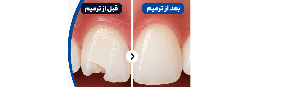 ترمیم کامپوزیت دندان